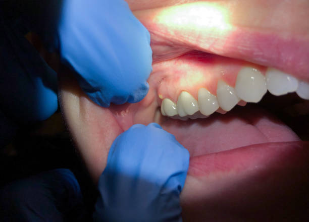 Best Dentist for Tooth Abscess  in Sarasota Springs, FL